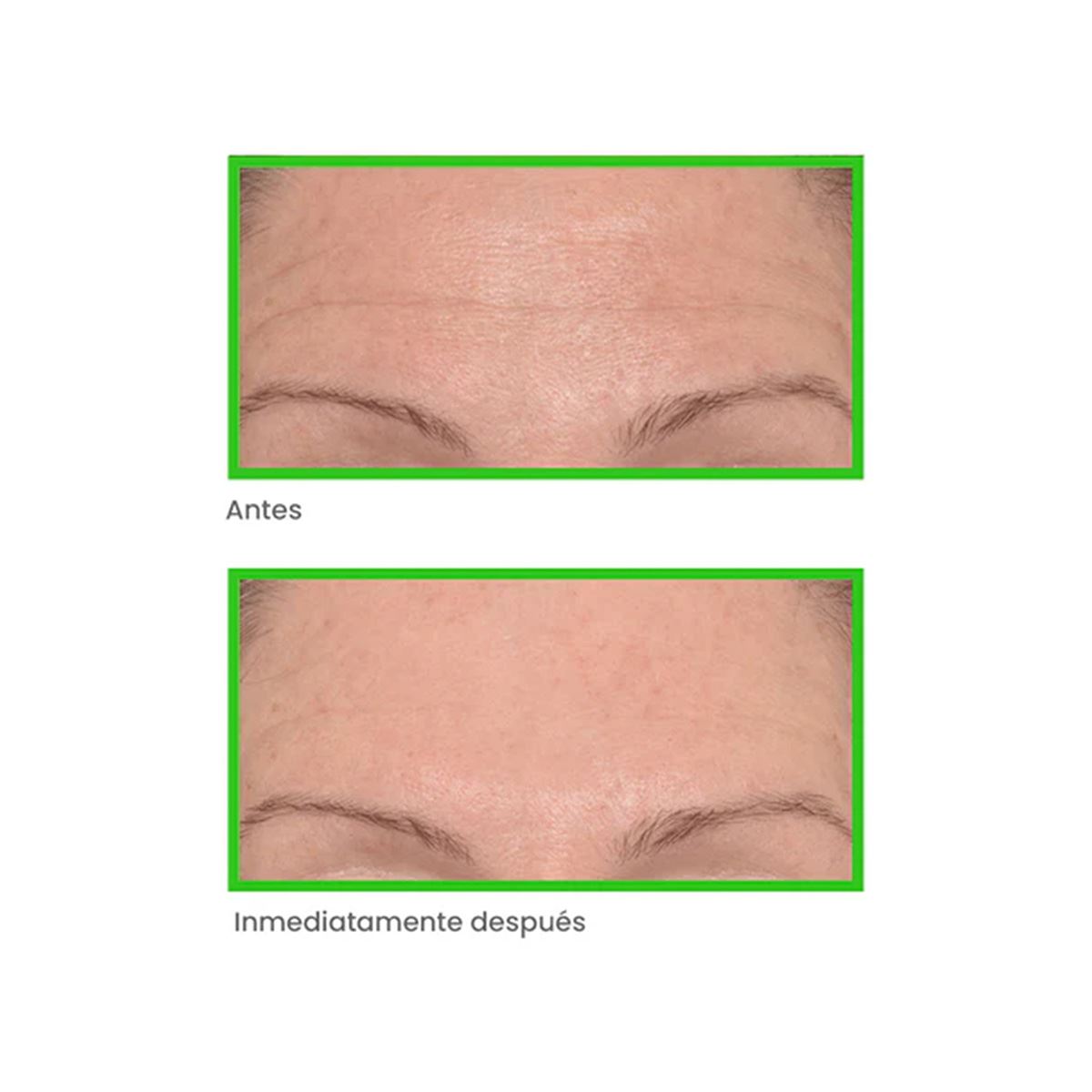 Set Rellenador de Arrugas Instantáneo Murad