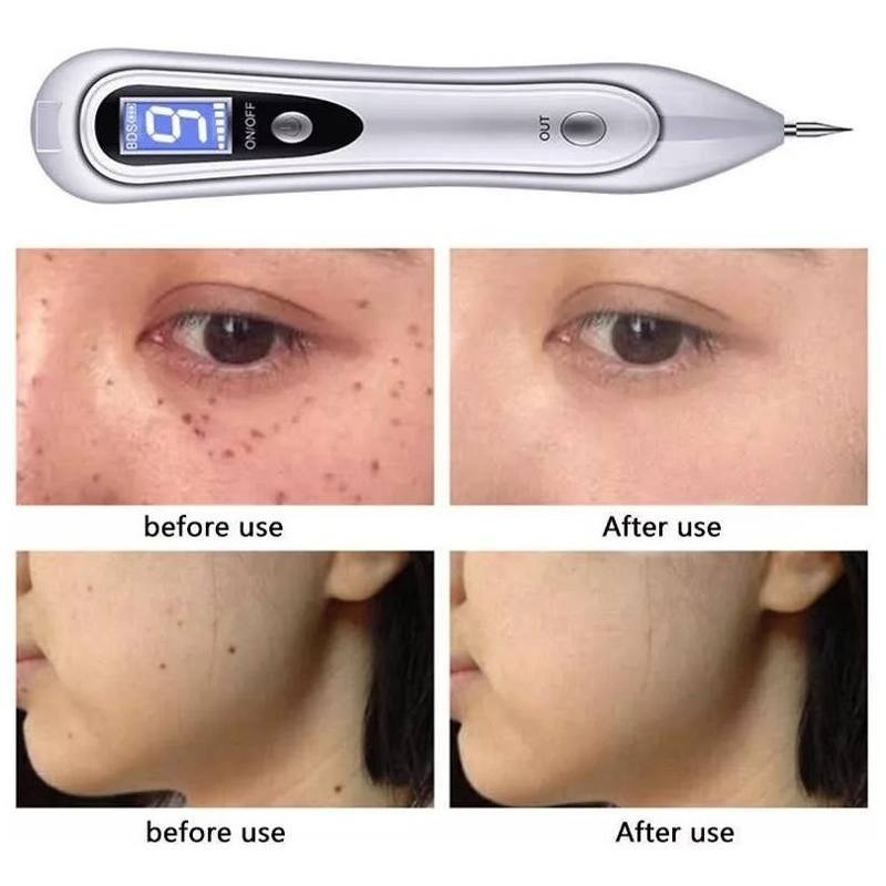 Cauterio Plasma Pen Removedor Verrugas Lunares Tatuaje Pecas Con 50 Repuestos Finos Y 3 Gruesos