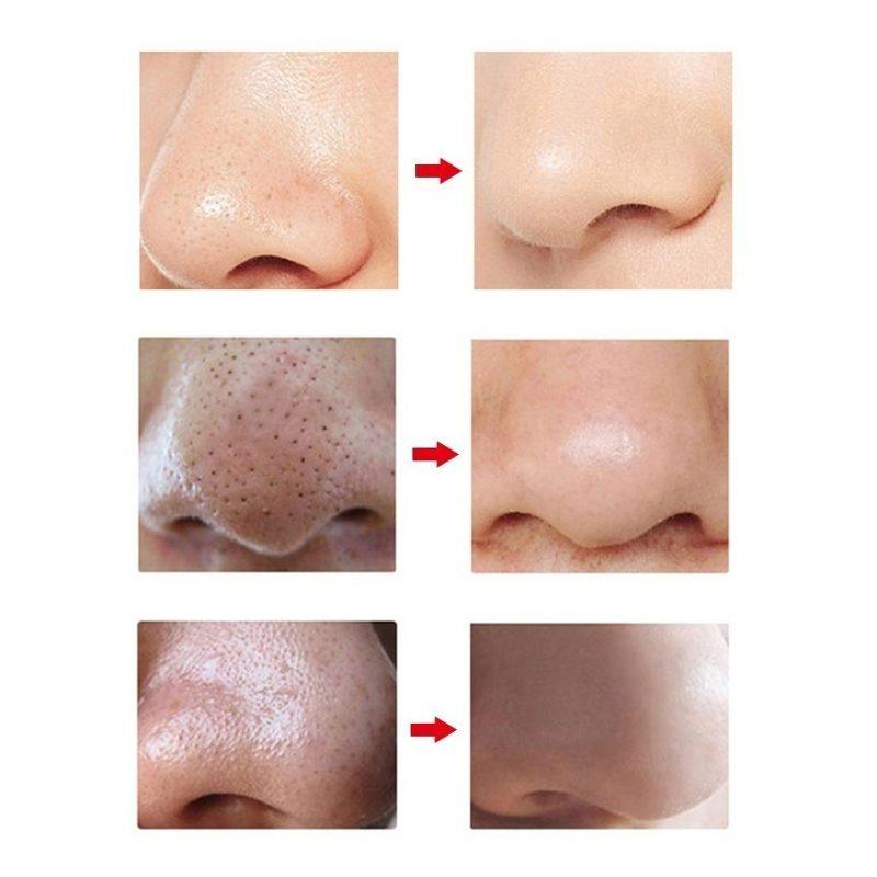 Limpiador Facial Poros Succión Puntos Negros Espinillas Acne Comedones Removedor de Imperfecciones