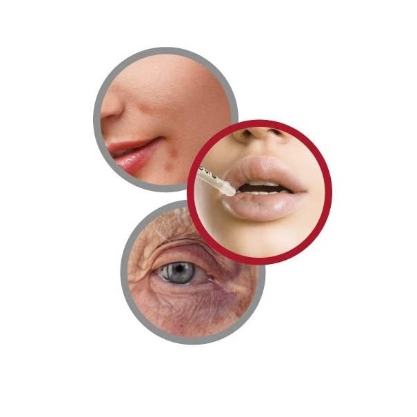 Hematix Gel 30g Desvanecedor De Moretones, Hematomas, Piel