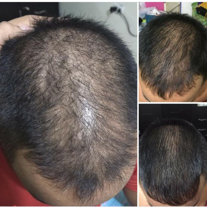 MINOXIDIL 7% Crecimiento de Cabello CosmexLab Ultra Strong 60 ml 6 meses