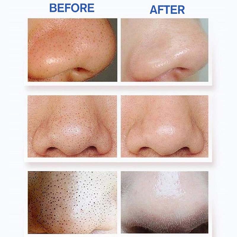 Para Eliminar Espinillas Y Puntos Negros,succión Al Vacío, limpiador de poros para el cuidado de la piel de la cara