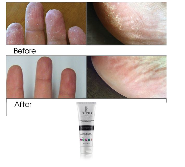 Crema Intensiva De Pies Para Piel Seca Prédiré 75ml