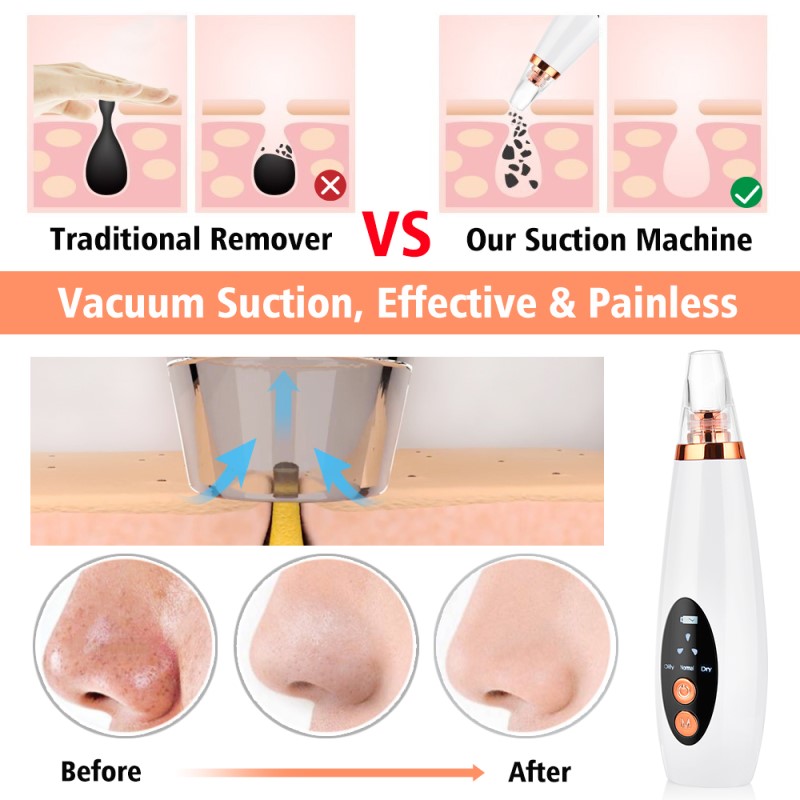 Limpiador Facial Poros Succión Puntos Negros Espinillas Acne Comedones Removedor de Imperfecciones