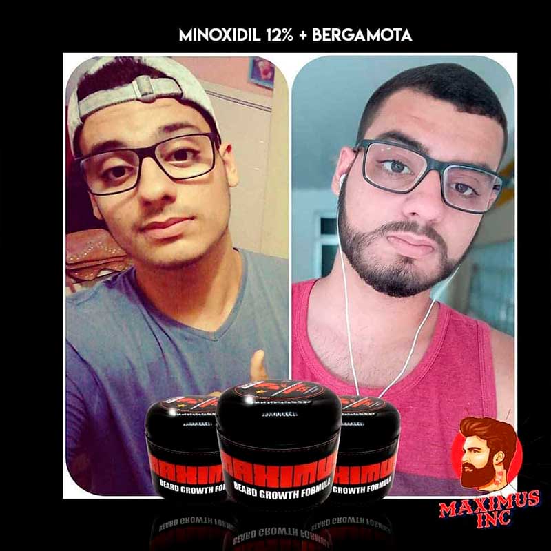 2 bálsamos de minoxidil al 12% Crecimiento de Barba y Bigote cerrar huecos | Haz crecer tu barba | Tapa huecos Sin tapar poros