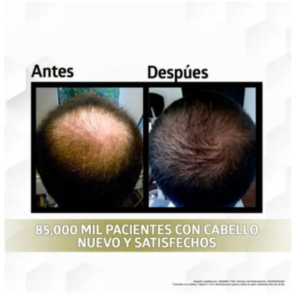 Sistema Gb Solución Alopecia 60 Ml. Minoxidil 5%