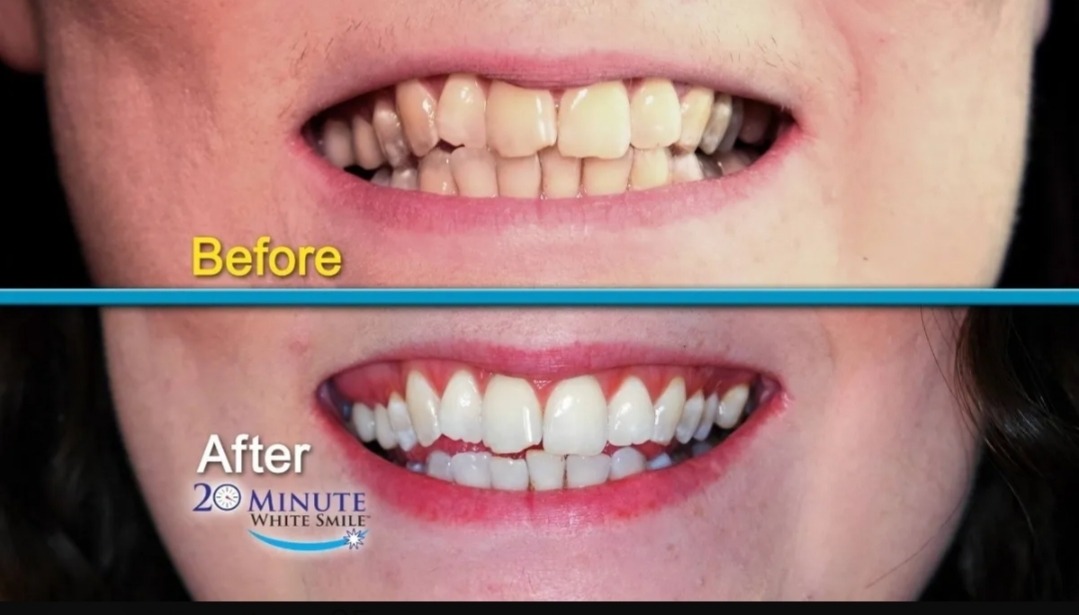 Sistema De Blanqueamiento De Dientes 20 Minutes White