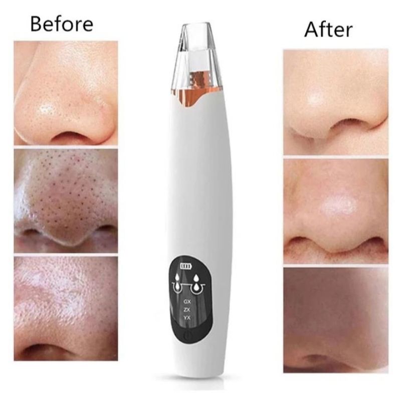 Extractor de Puntos Negros, LBP, Dispositivo de Belleza Facial, Exfoliador