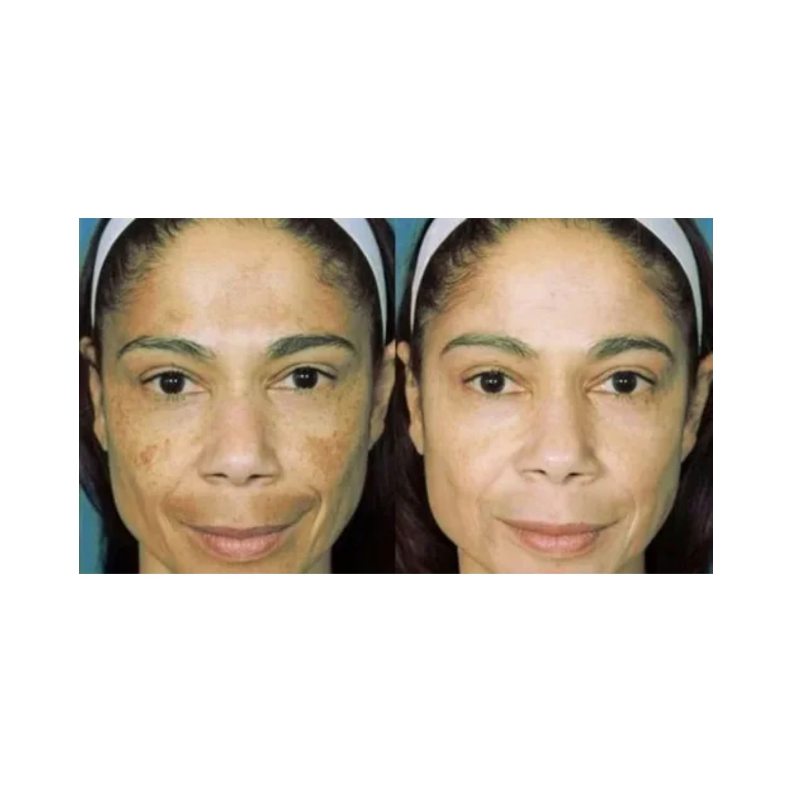 Crema Blanca Bustillos Hidroquinona Frasco 40 gr