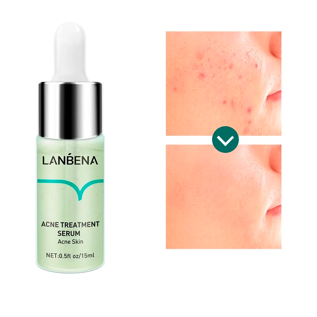 Colágeno Vitamina C Ácido Hialurónico Anti-Acne Set Facial 5 Piezas Antiedad