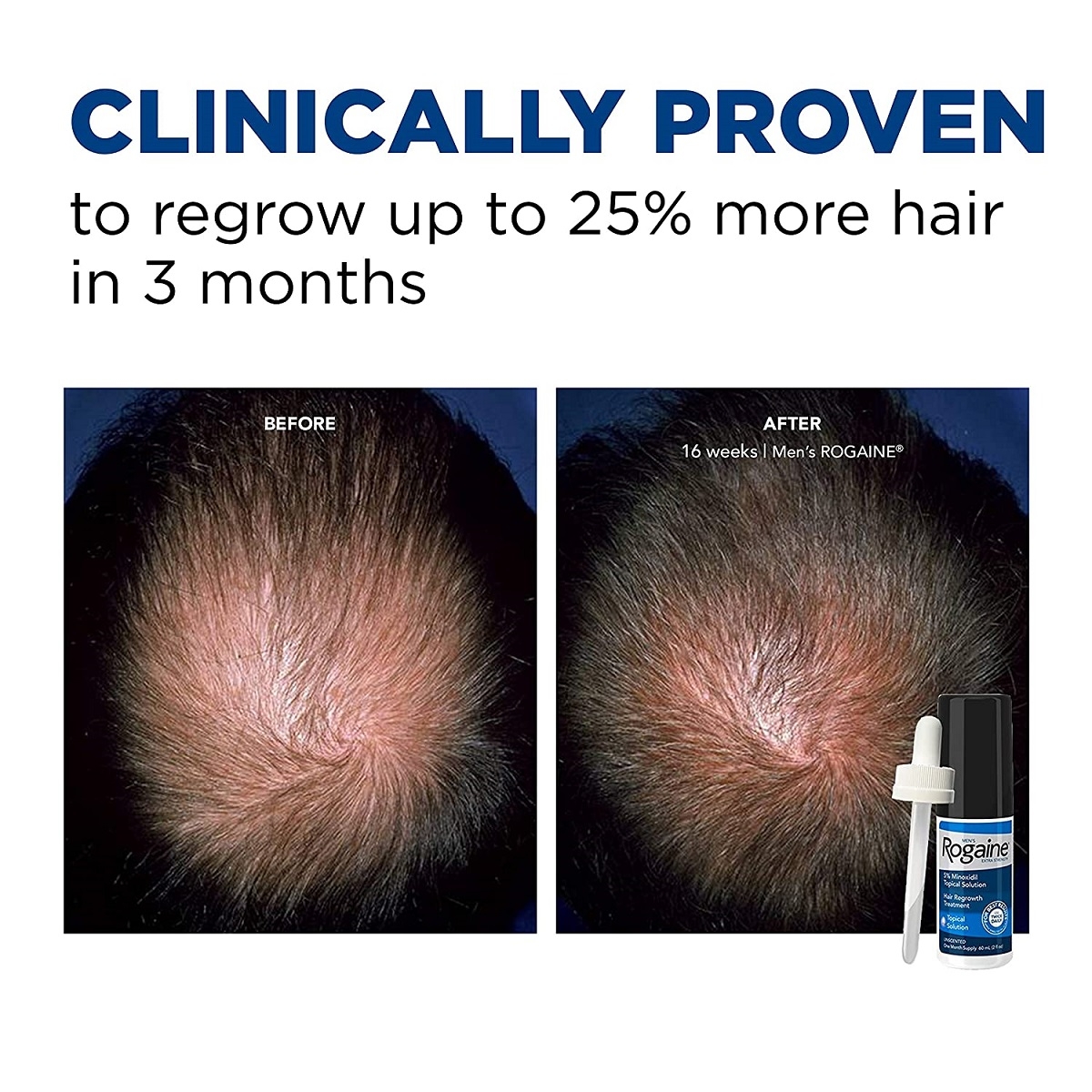 Minoxidil Rogaine 5% Tópico Crecimiento Cabello Barba Cejas 1 mes