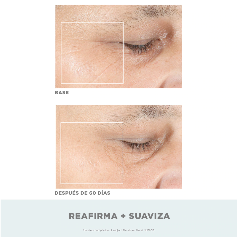 NuFACE Trinity Facial con aditamento ELO