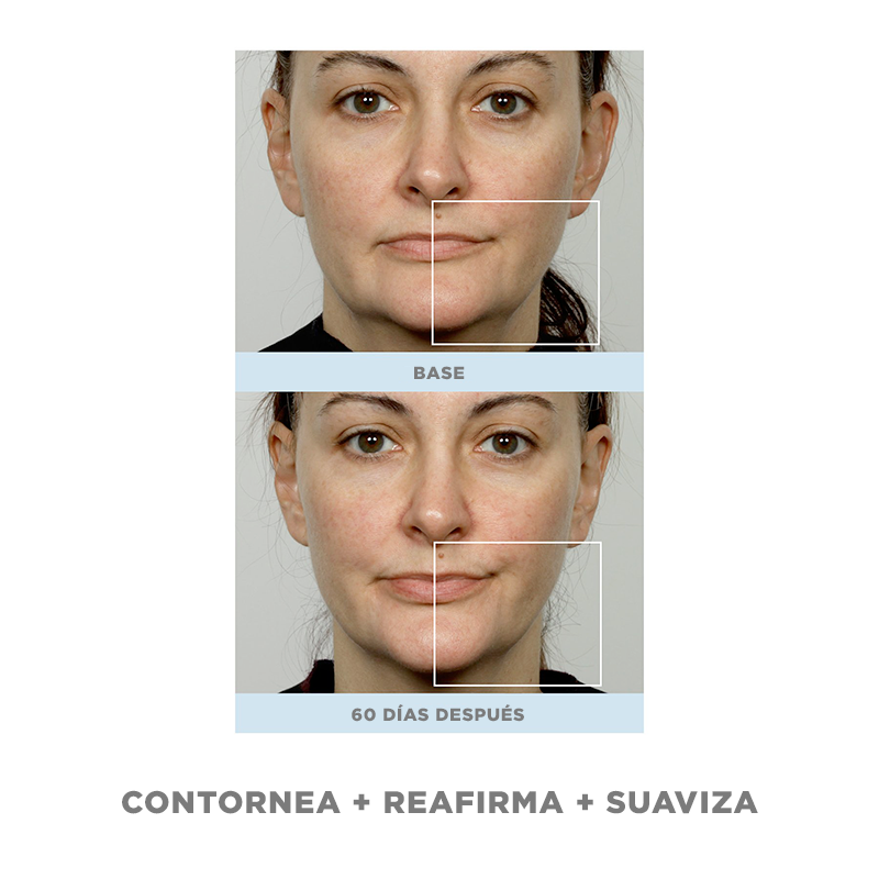 NuFACE Trinity Facial con aditamento ELO