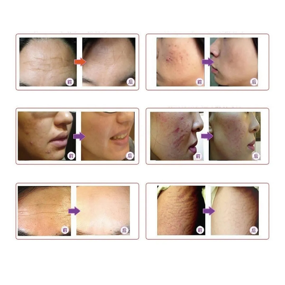 Dermapen Dr Pen Ultima M7 Borra Cicatrices Arrugas Metalico