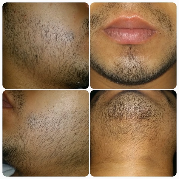 Minoxidil Crecimiento De Barba y Bigote