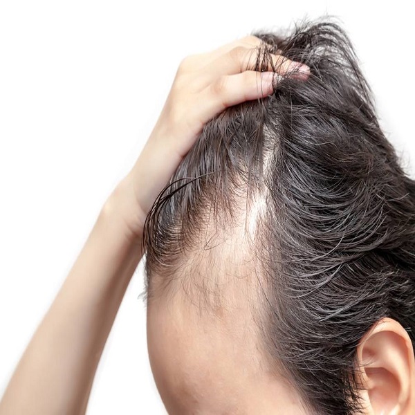 Minoxidil Crecimiento De Cabello Con Bergamota y Biotina