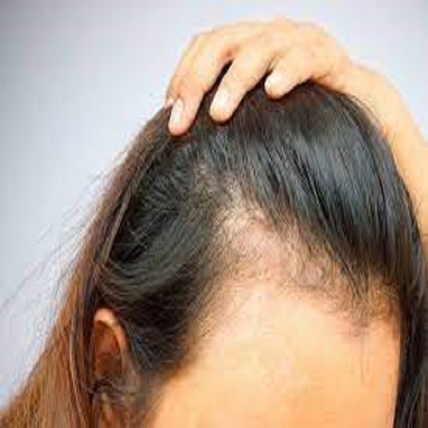 Minoxidil Crecimiento De Cabello Con Bergamota y Biotina