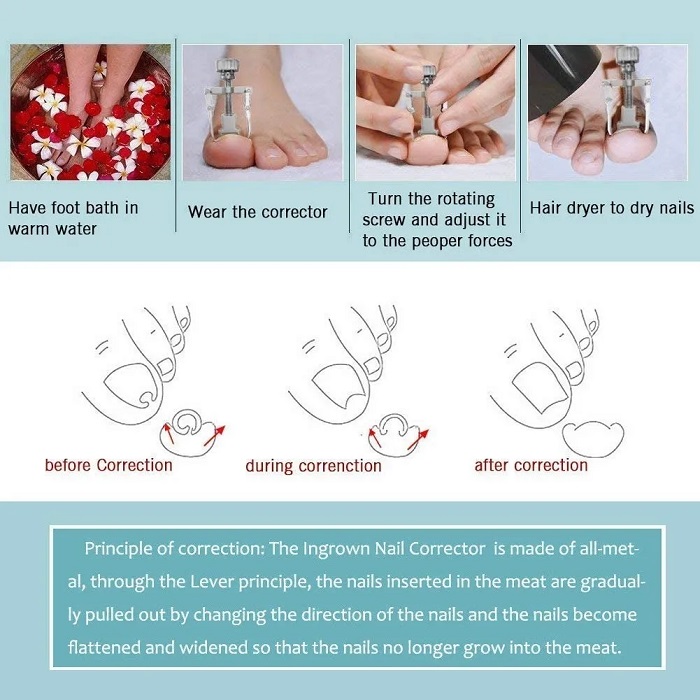 Kit De Herramientas Para Uñas Encarnadas 6 Piezas