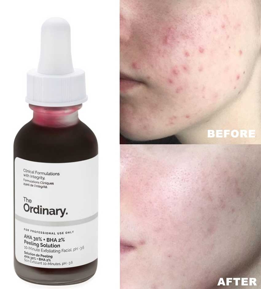 The Ordinary AHA 30% + BHA 2% Peeling Solution 30 ml