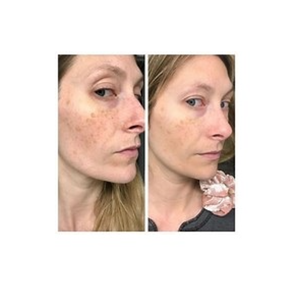 The Ordinary Retinol 1% in Squalane