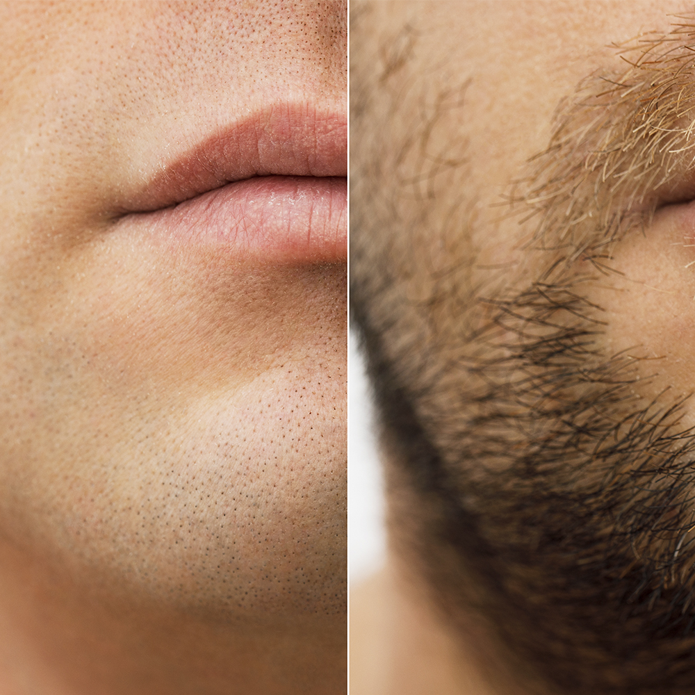 Minoxidil Pastillas 5mg Oral Minoxytop