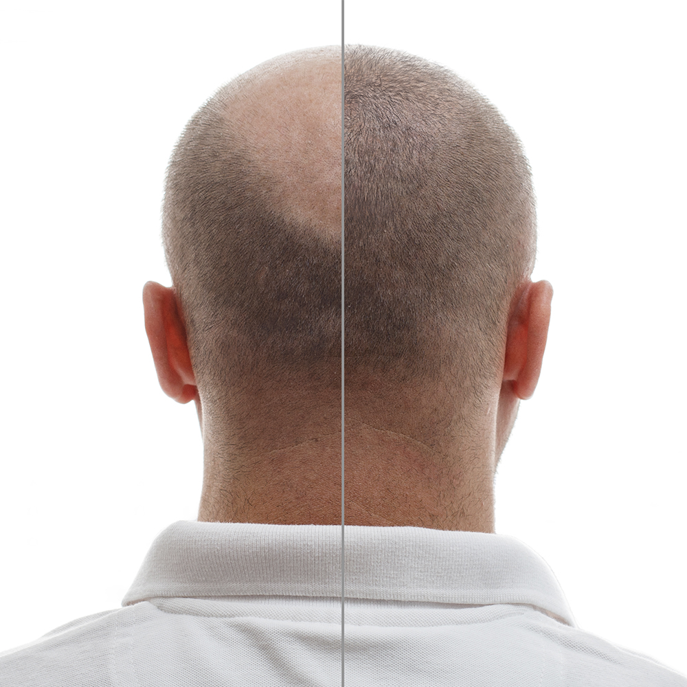 Minoxidil Pastillas 5mg Oral Minoxytop