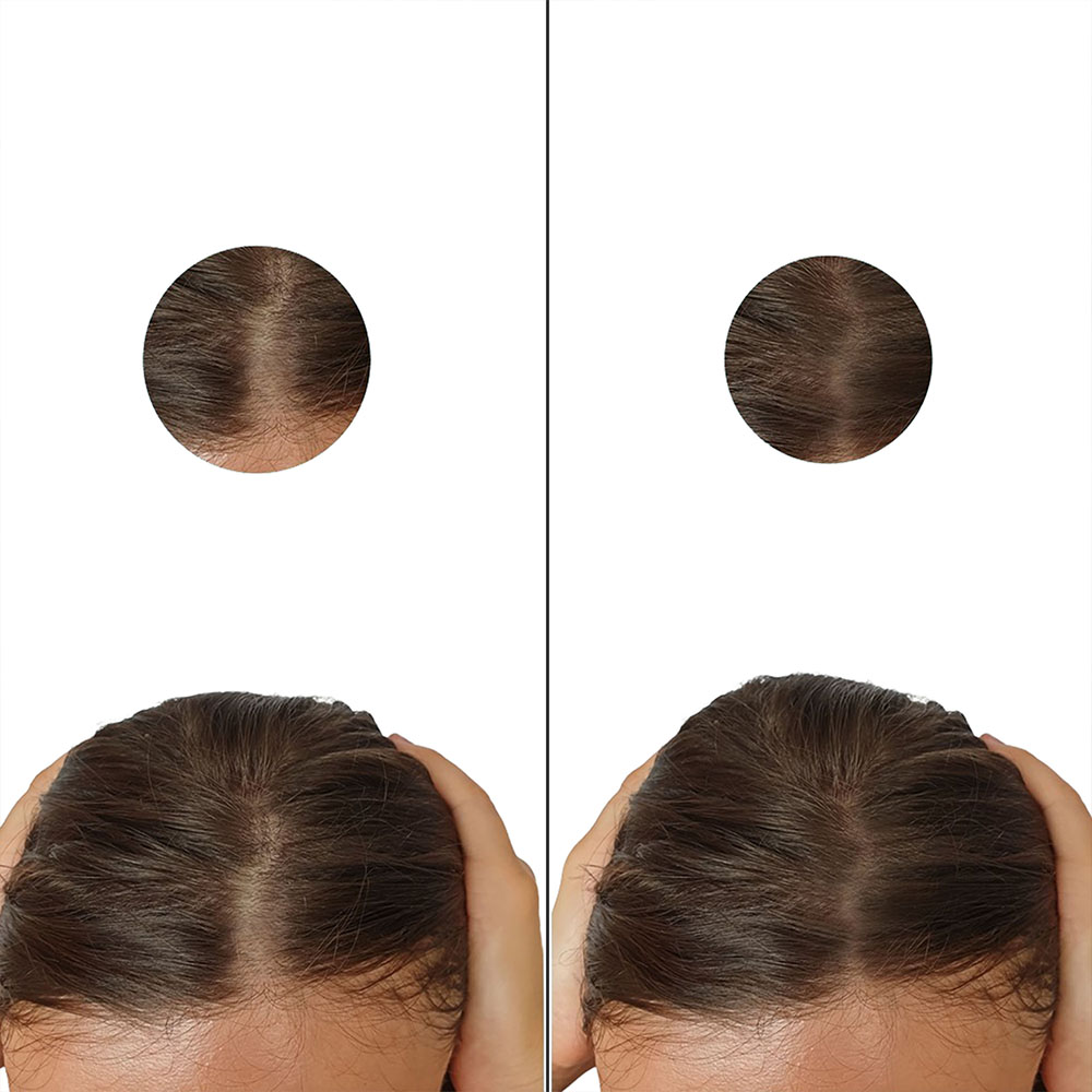 Minoxidil Pastillas 5mg Oral Minoxytop