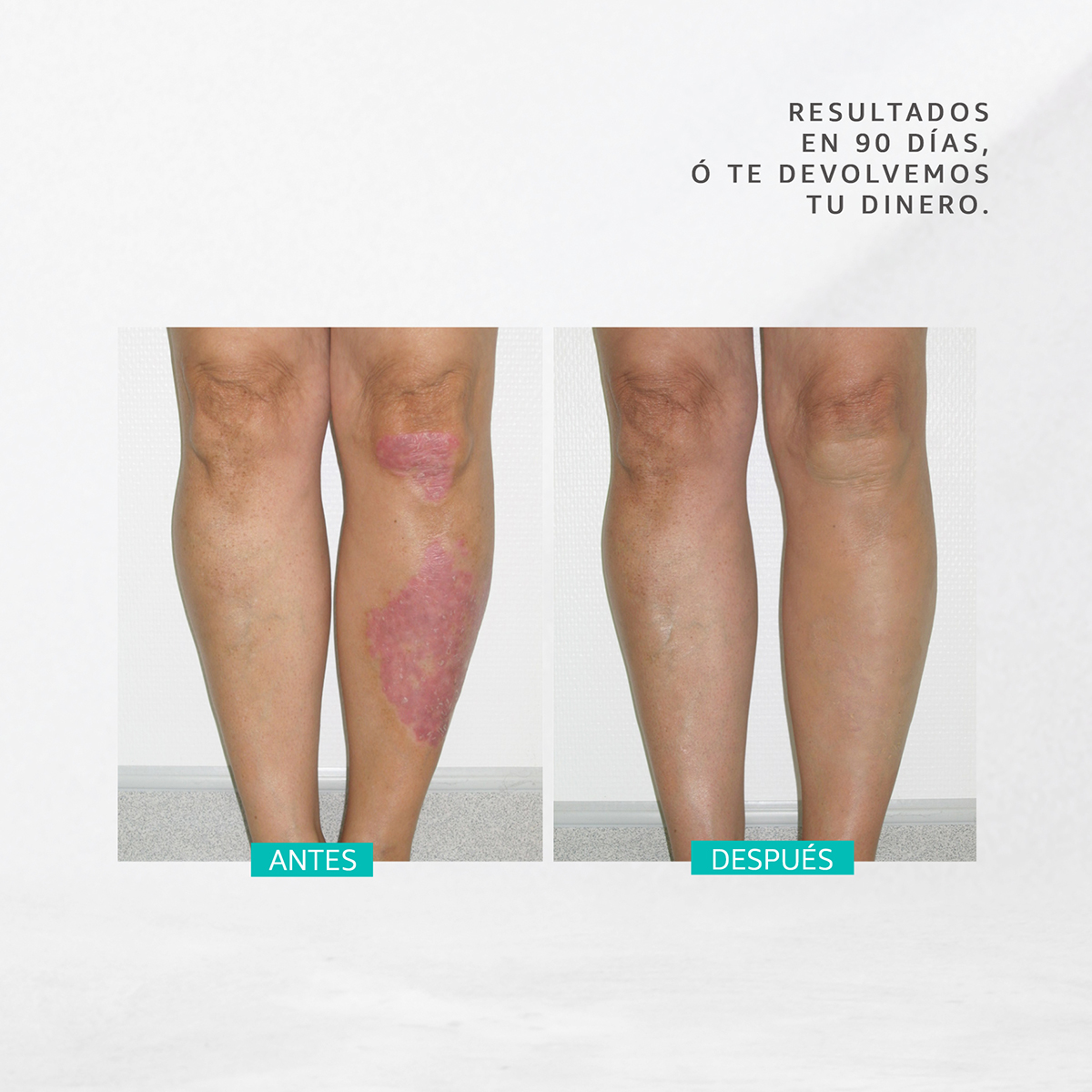 Jabón Para Tratamiento Psoriasis y Dermatitis, Dermabon