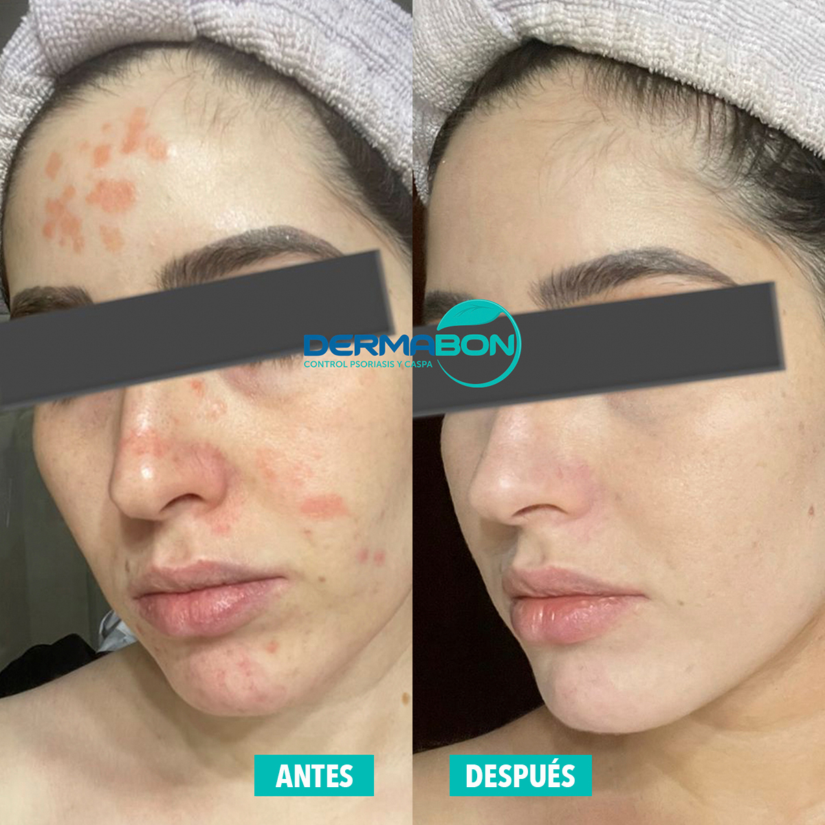 Jabón Para Tratamiento Psoriasis y Dermatitis, Dermabon