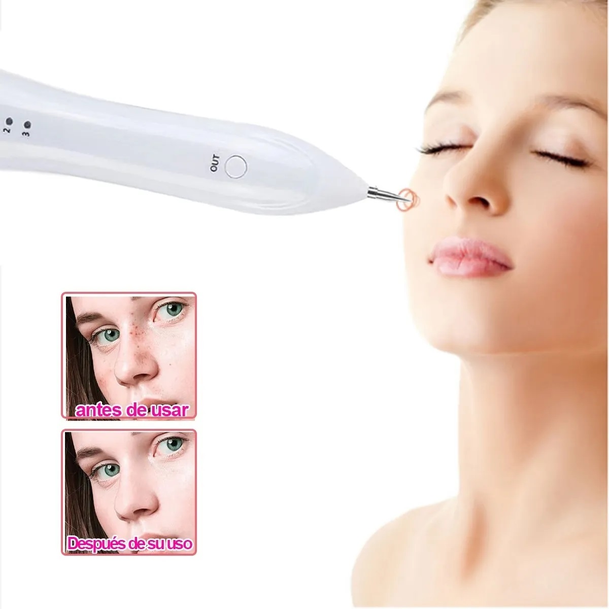 Eliminacion De Verrugas Cauterizador, Mancha