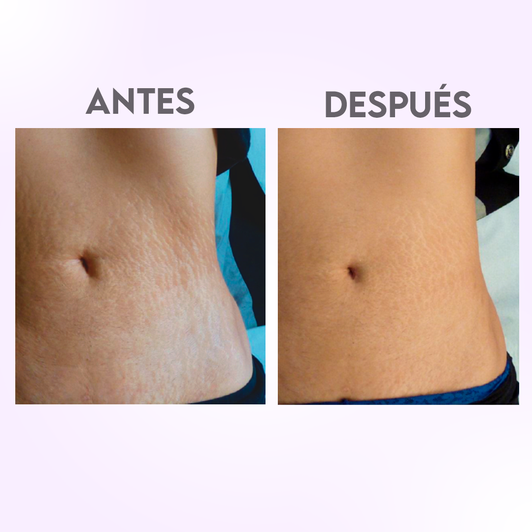 Crema Baba De Caracol Elimina Estrías Y Celulitis 500ml