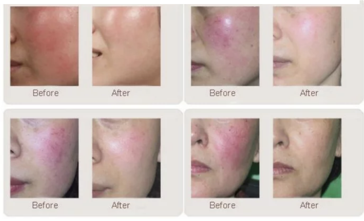 LASER 980 ELIMINACION DE VENAS DE ARAÑA