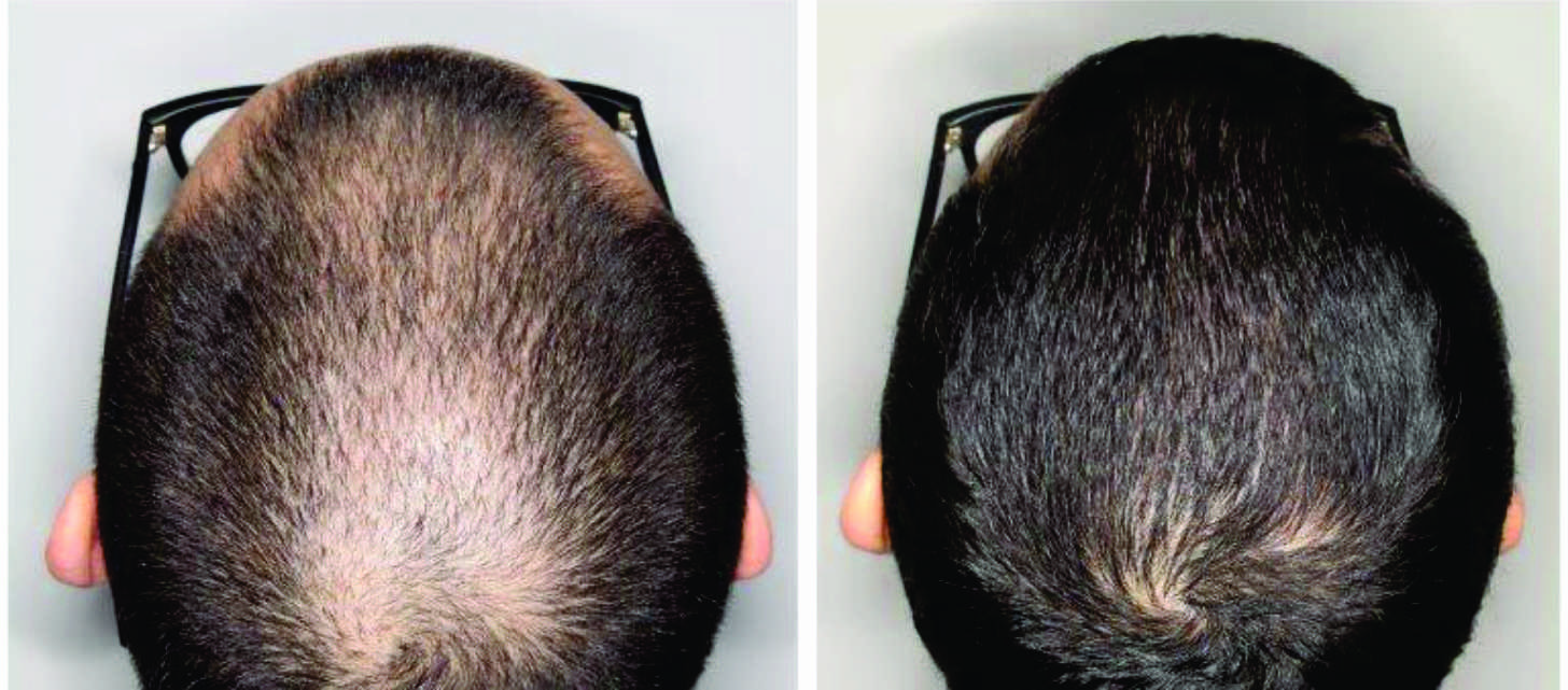  Loción MINOXIDIL 7% Fortificada con Biotina para Crecimiento De Cabello  60 ml 1 Mes