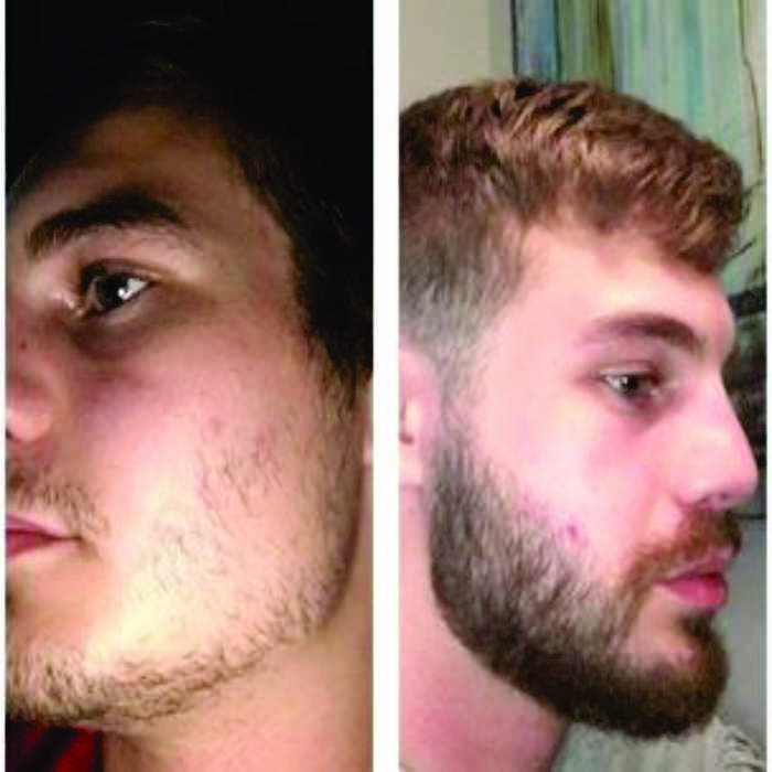 Loción MINOXIDIL 7% Fortificado con Bergamota para Crecimiento de Barba y Bigote 3 meses