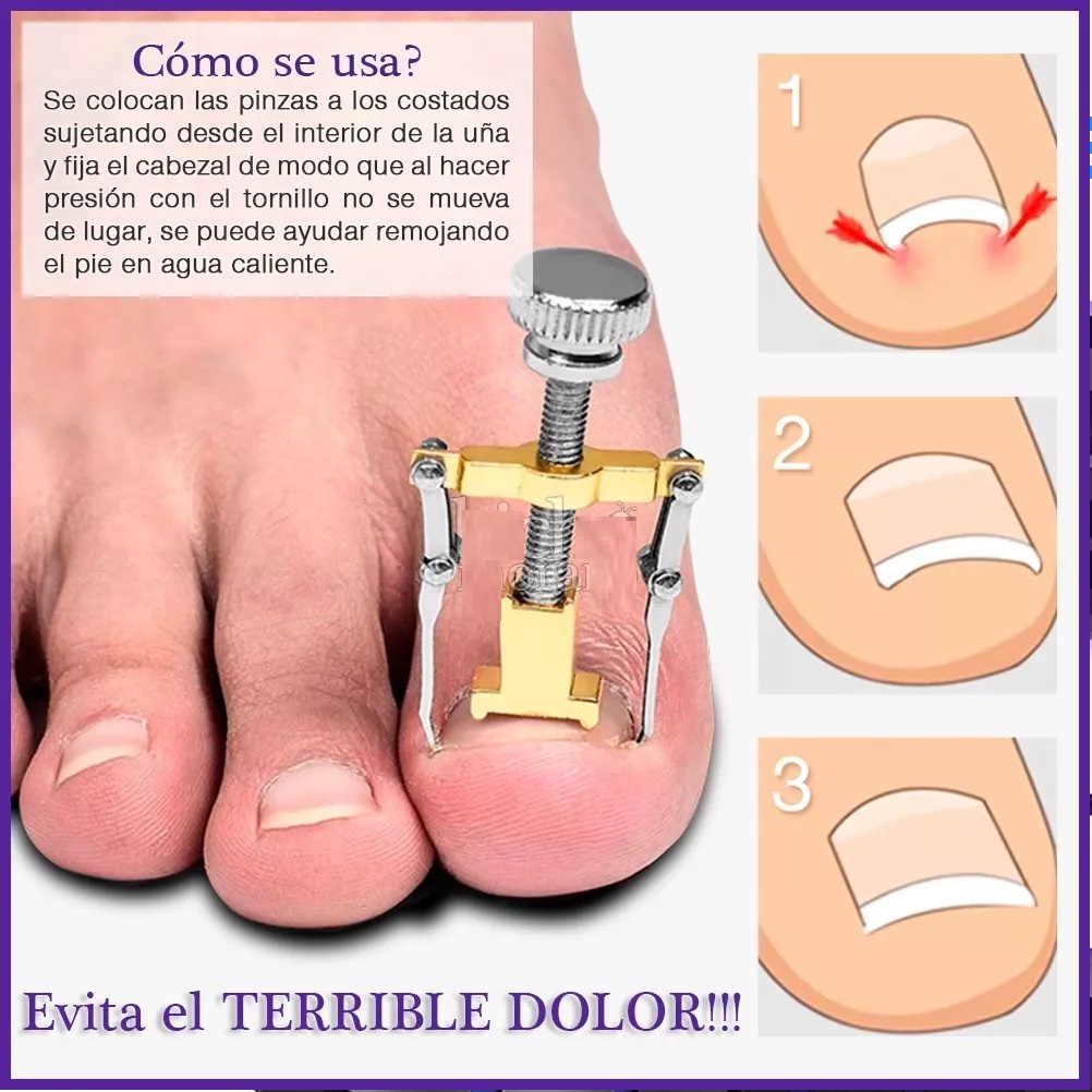 Herramienta Para Sacar Uñas Enterradas Removedor