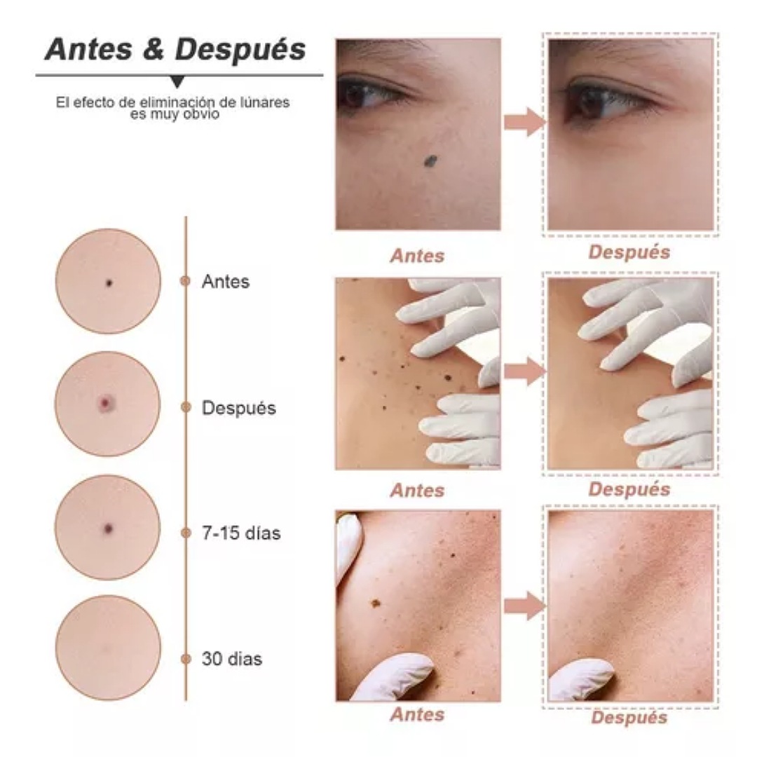 Herramienta Para Quitar Verrugas Ciicii Pluma Cauterizador por CIICII