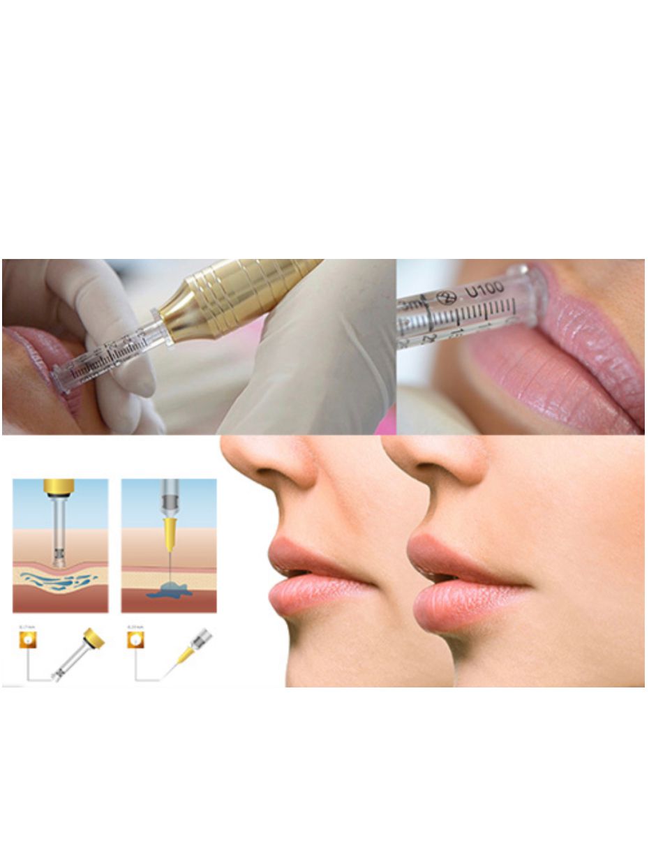 Hyaluron Pen Hialuronic Mesoterapia Rellenos 