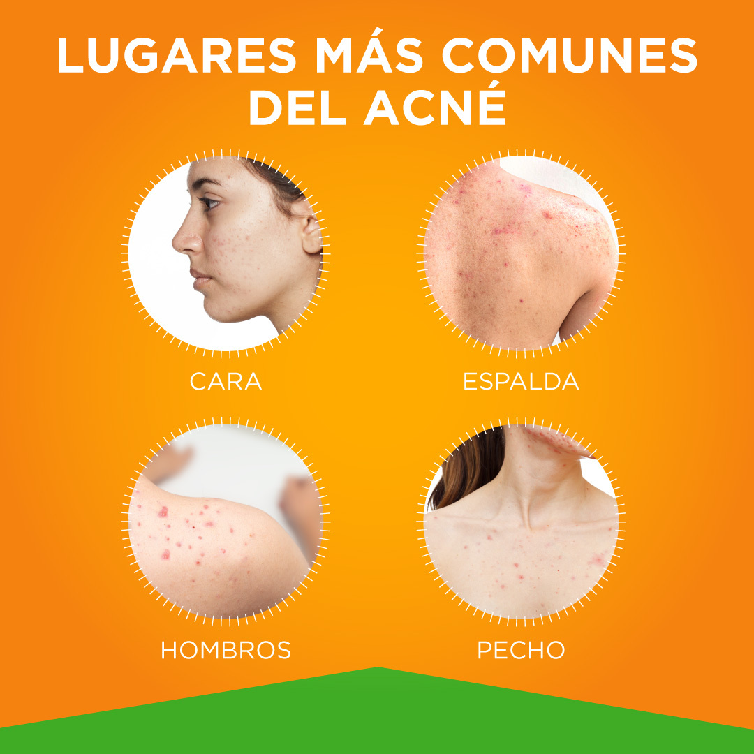 Gel Antiacné Trioxi-tree Con Ozono 