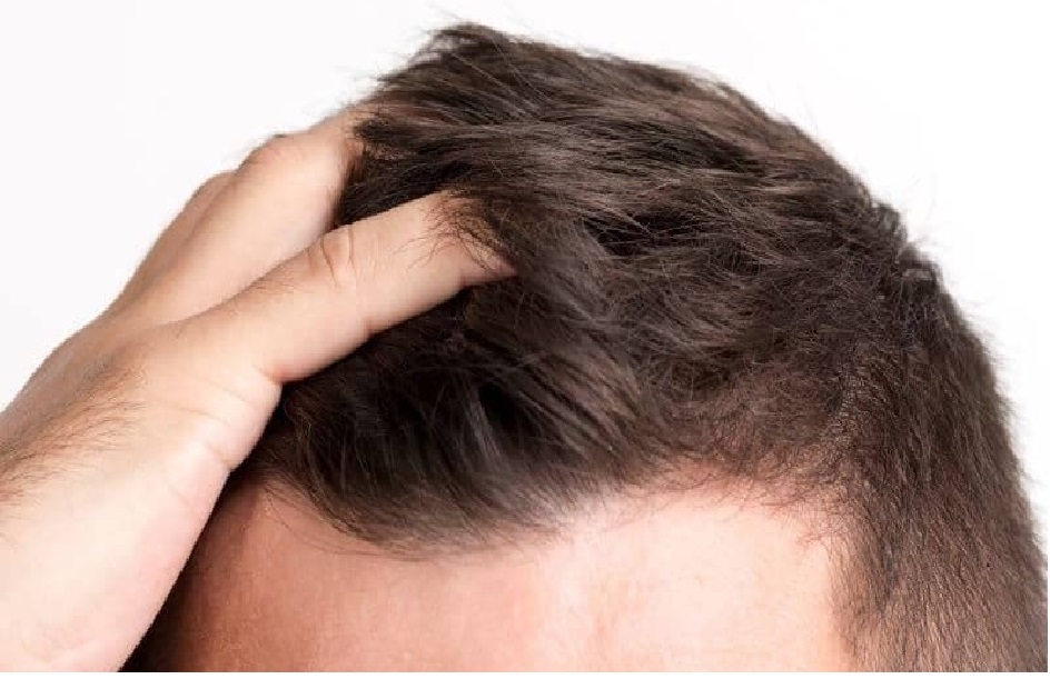 Minoxidil 15% + Finasterida 0.1% + Biotina.  Solución Alopecia 6 meses.