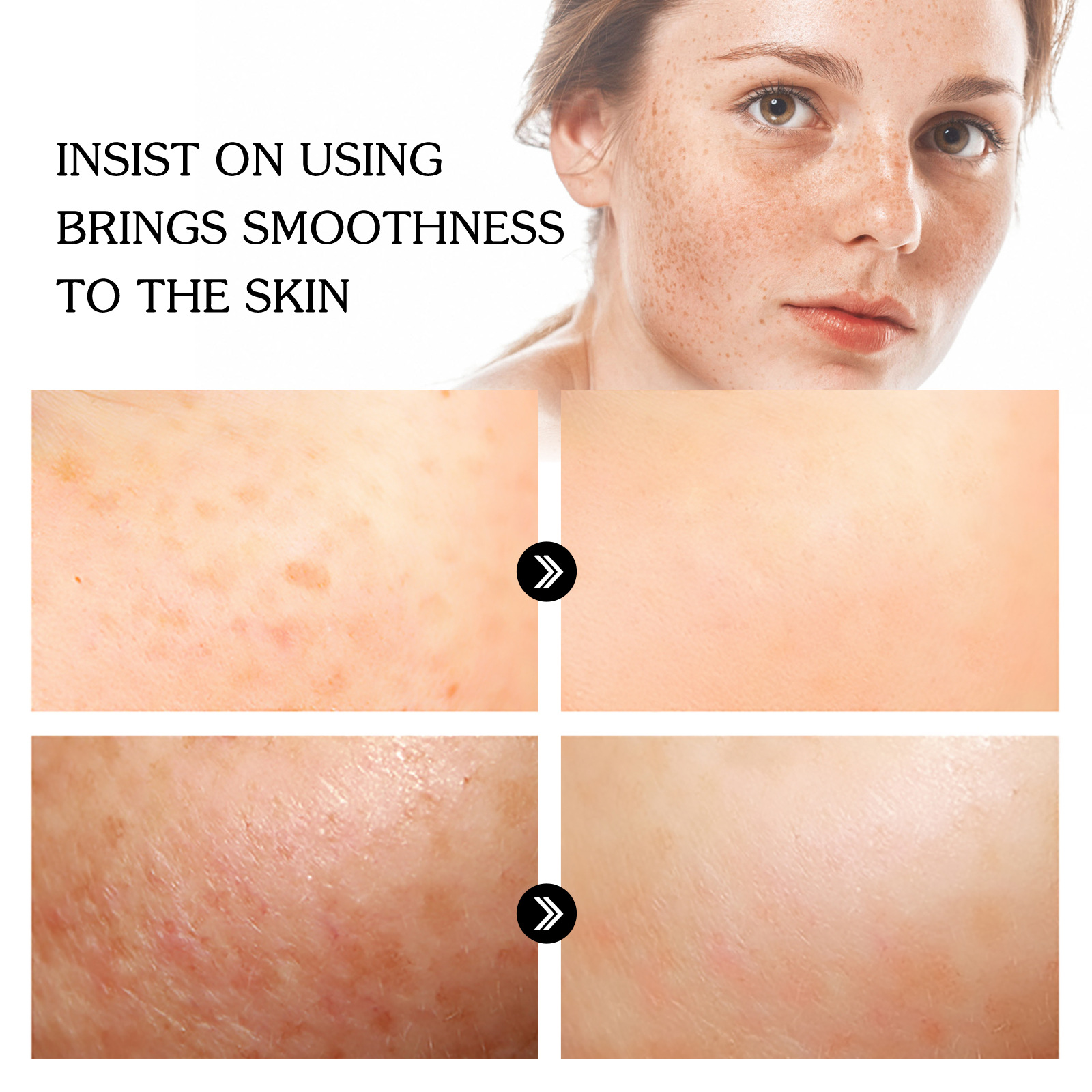 Serum blanqueador de pecas, elimina  manchas oscuras JAYSUING