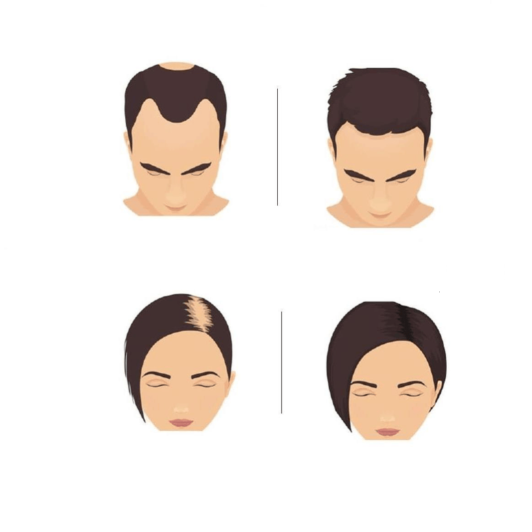 Follics Fr10 Minoxidil 10% Solucion Capilar 6 Frascos