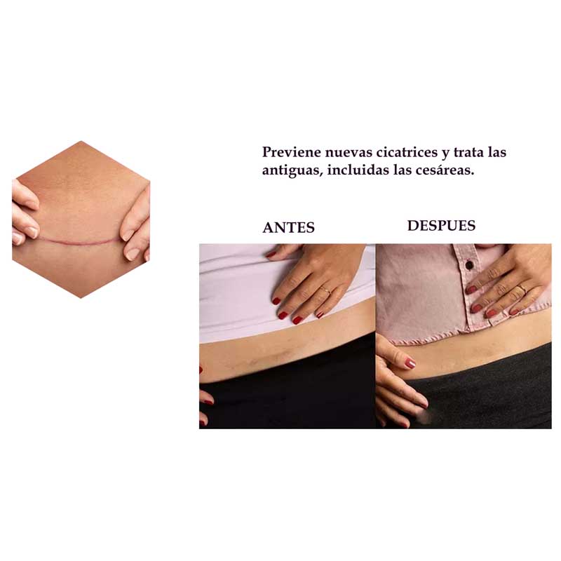 Parches de Silicon ScarAway Elimina Cicatrices de Cesareas 4pzs