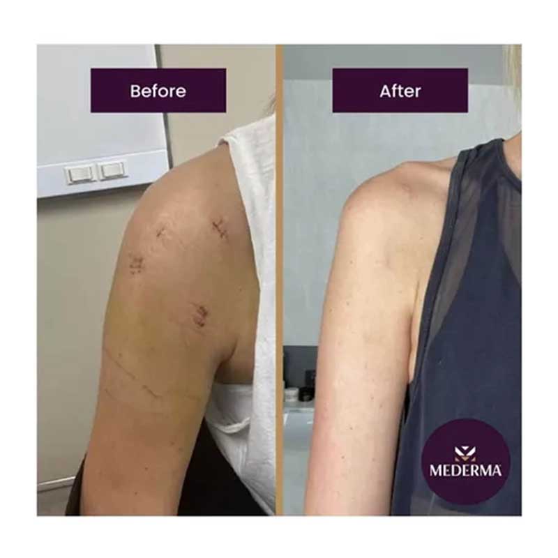 Gel Mederma Desvance Elimina Cicatrices en Cara y Cuerpo 50grs 