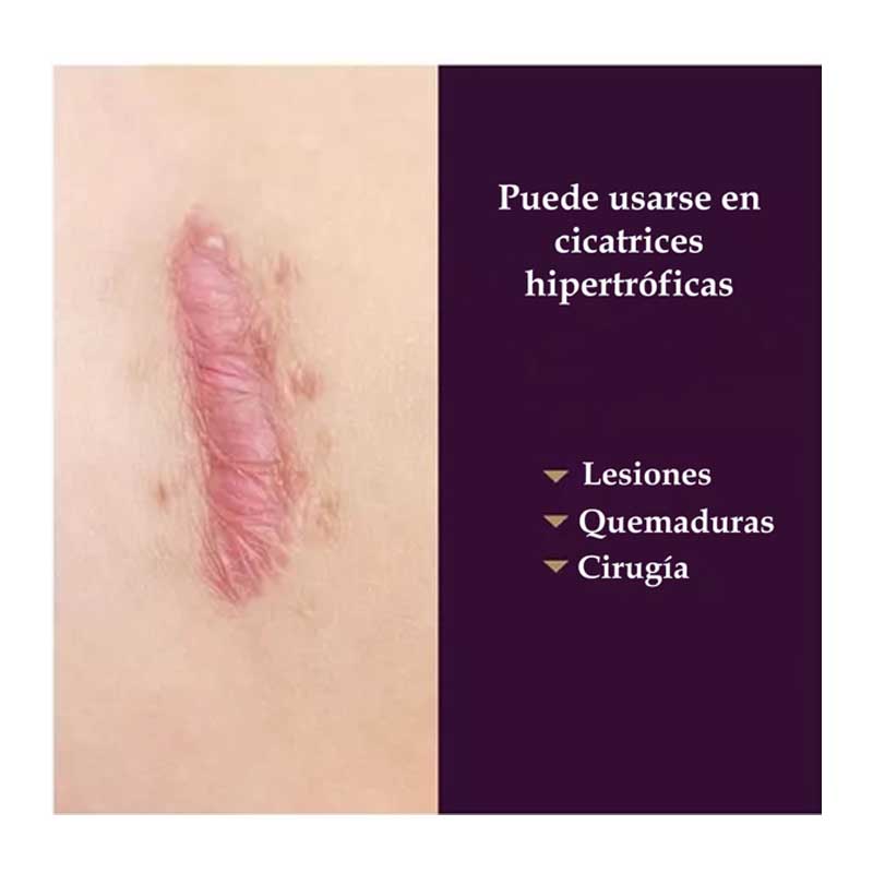 Parche Elimina Cicatrices Mederma Parche de 1.4" x 7" Cicatrización Grande 