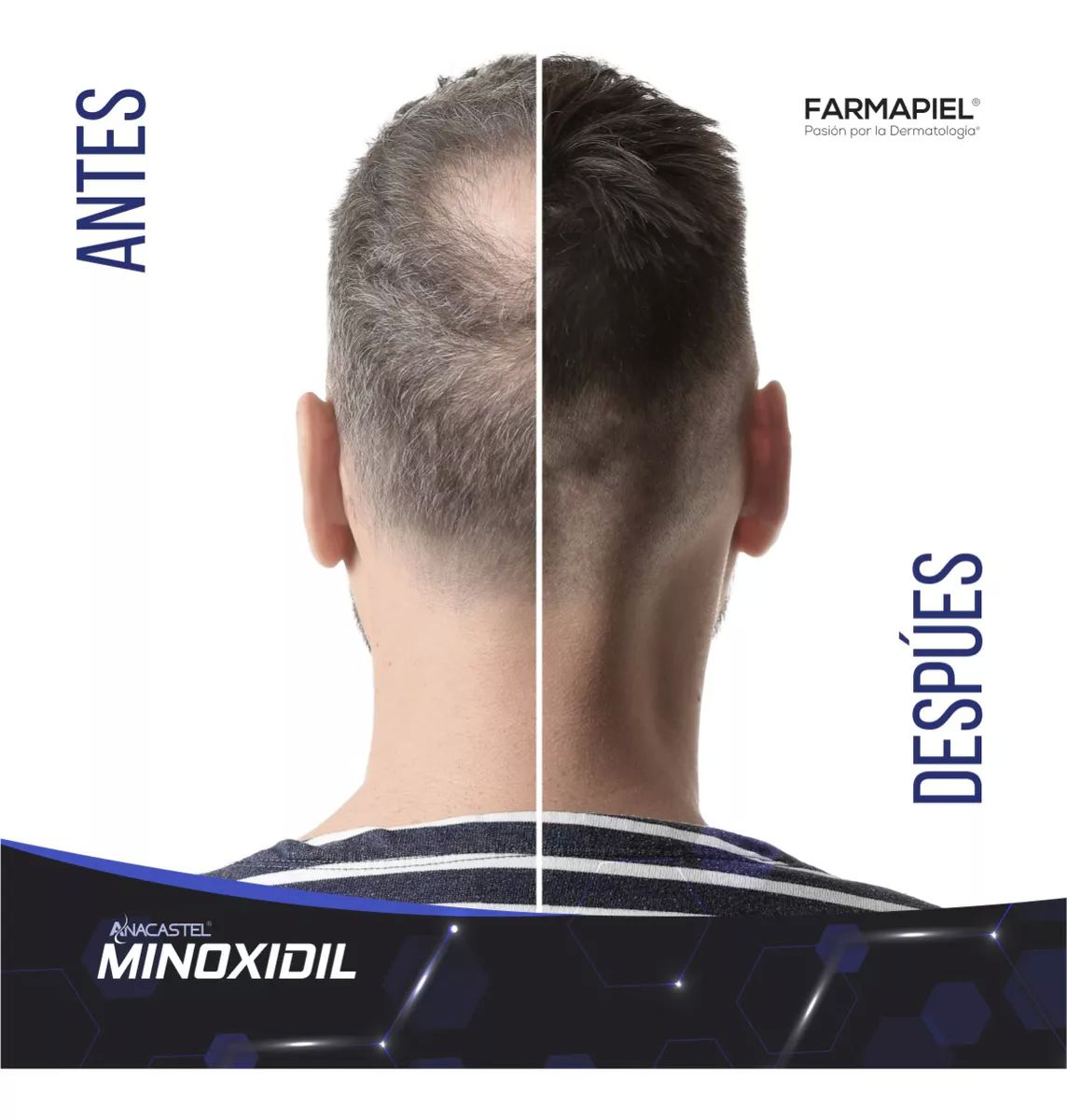 Spray Anacastel Minoxidil 5 POR CIENTO Solución Cabello Y Barba 60 Ml