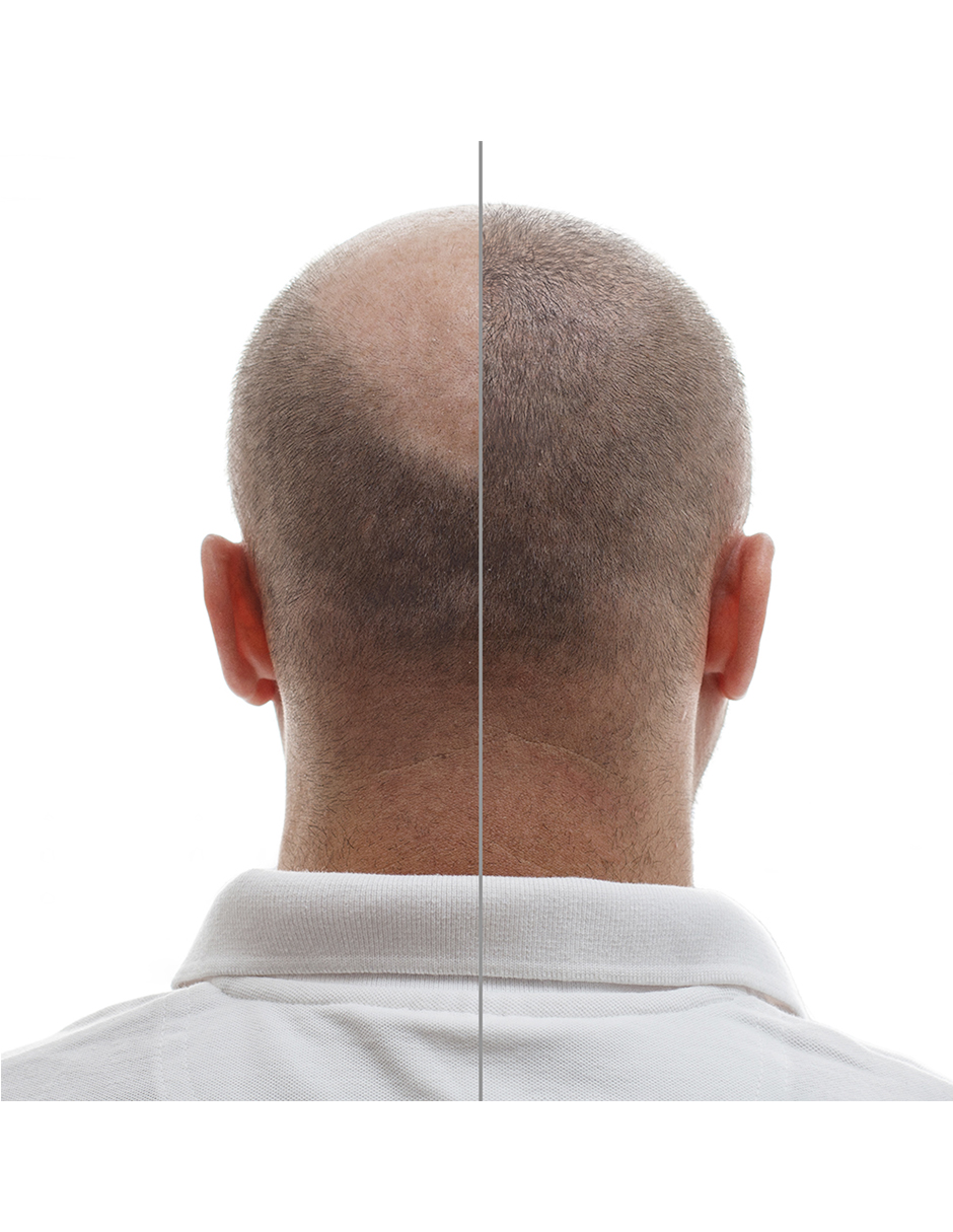 Minoxidil 2.5mg 60 Tabletas.