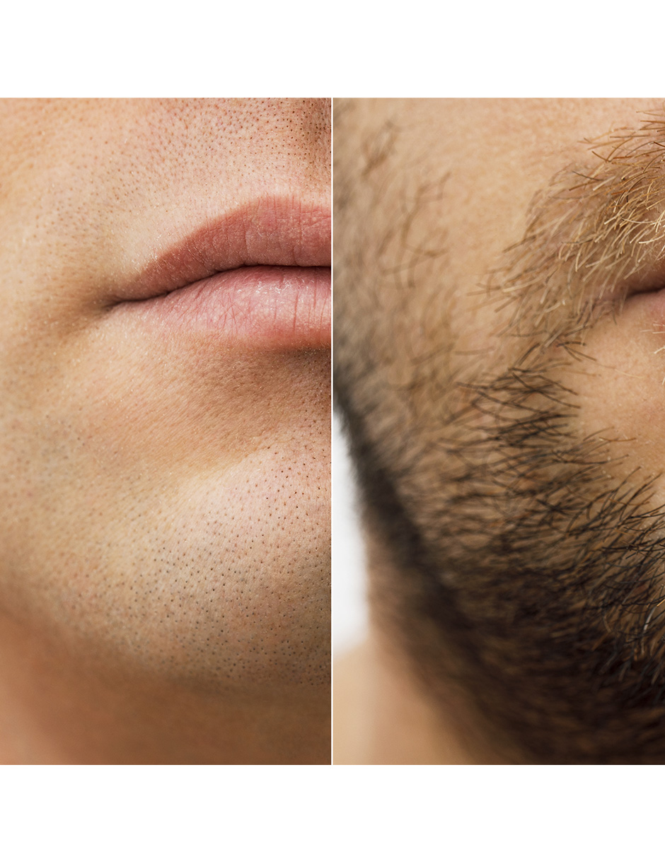 Minoxidil 2.5mg 60 Tabletas.