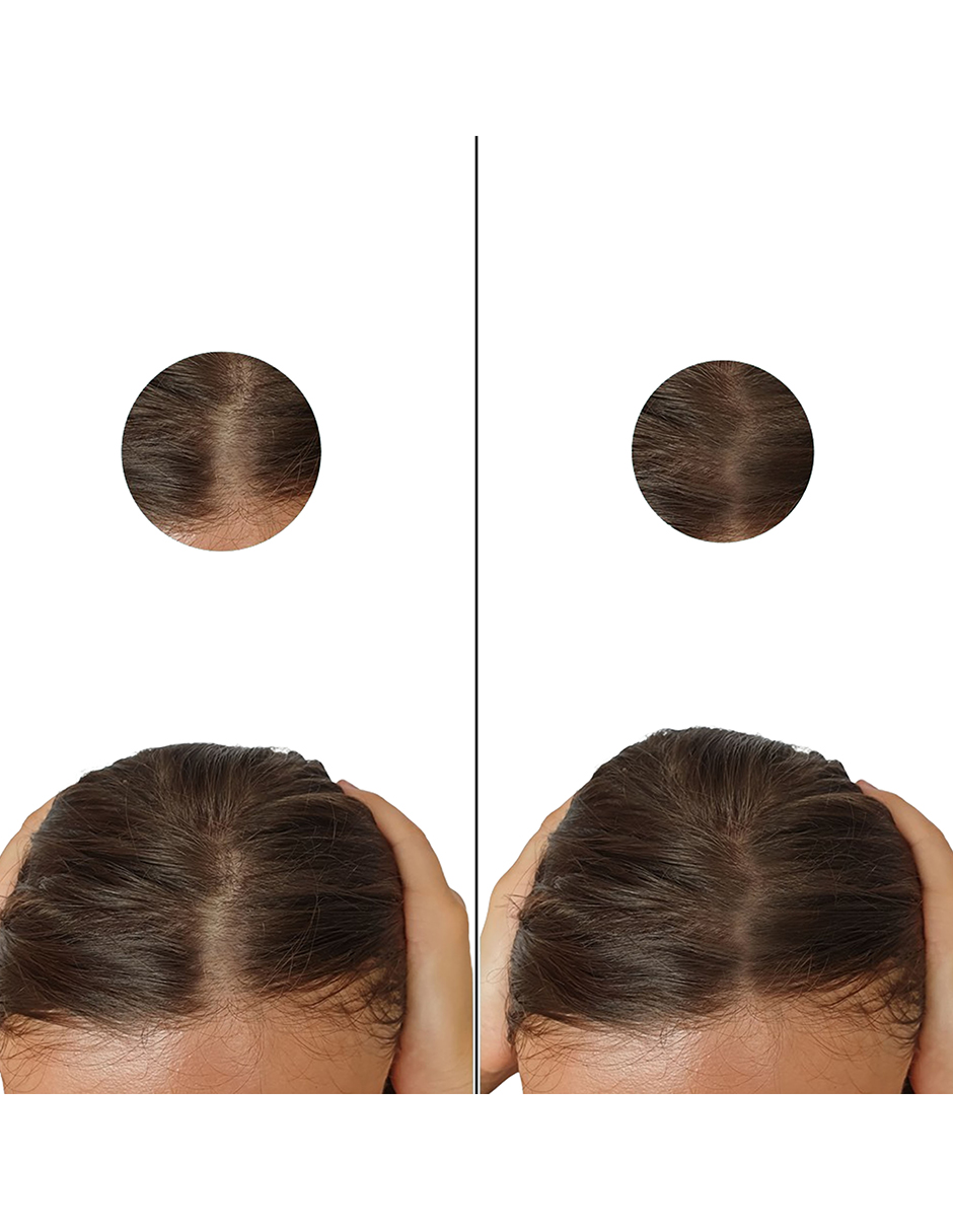 Minoxidil 5mg 30 Tabletas Minoxypark 3 Cajas