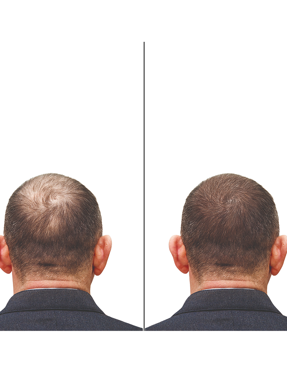 Minoxidil 5mg 30 Tabletas Minoxypark 3 Cajas