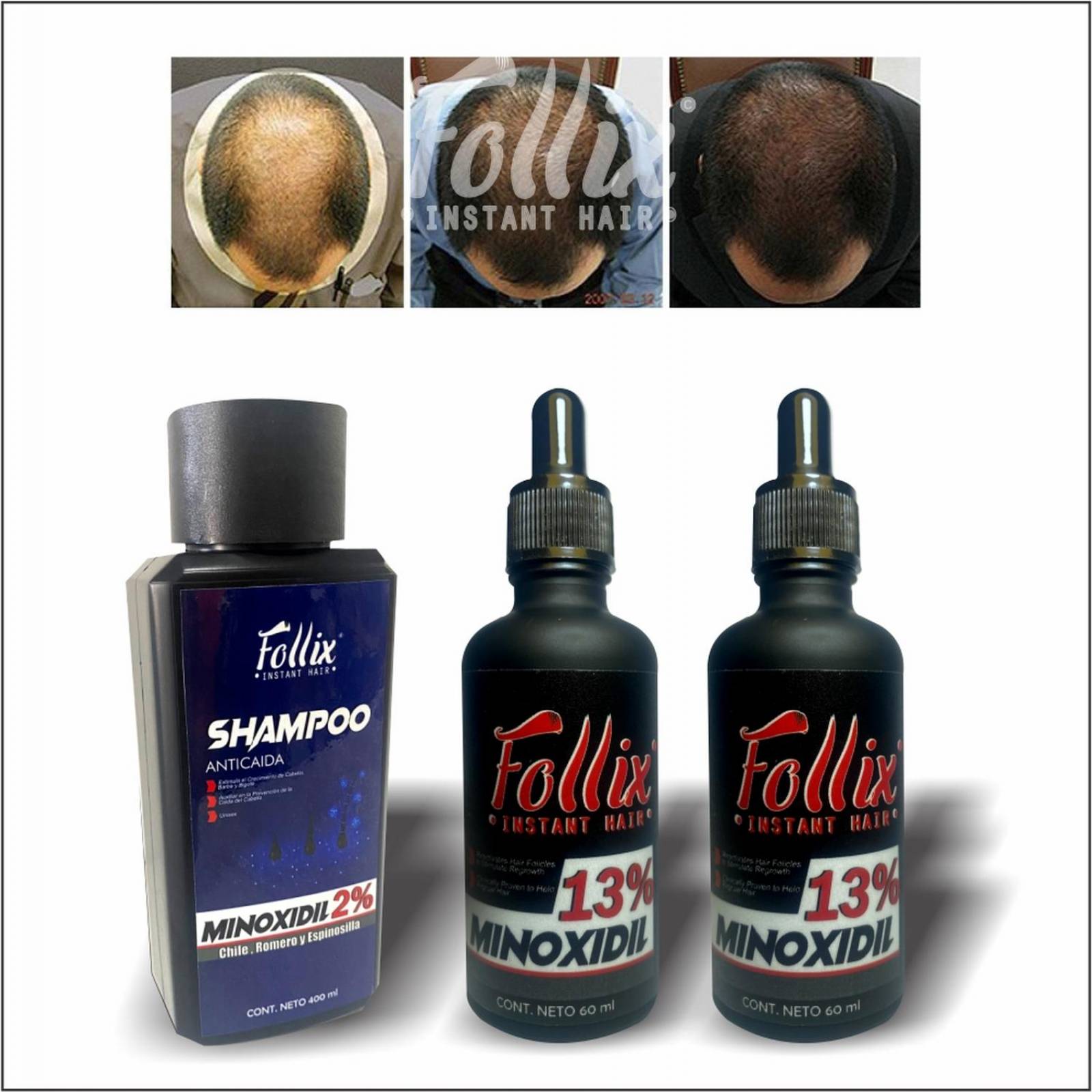 Kit Stop Alopecia 2, Con 2 Minoxidil 13 Y Shampoo Minoxidil 